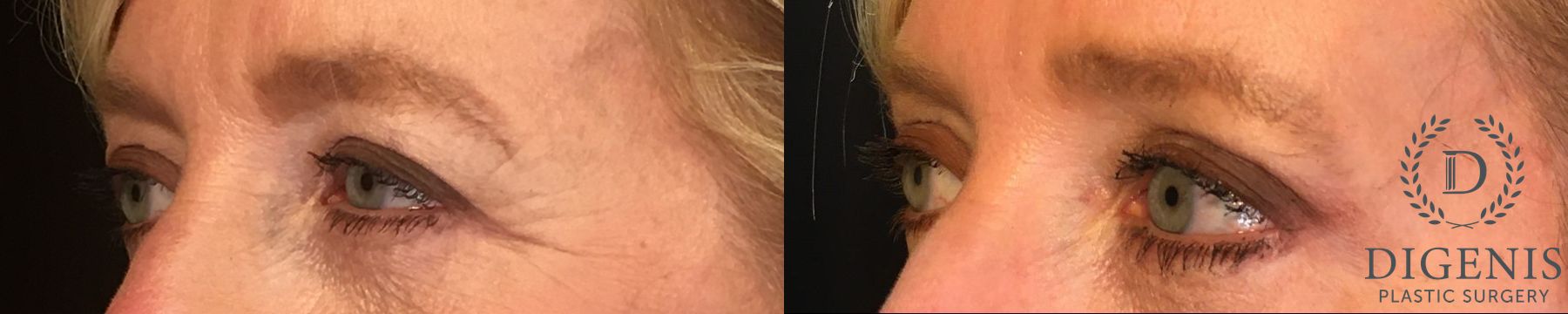 Before and after Eye Lid Surgery case 35154 - Angle 4