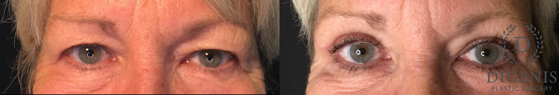 Before and after Eye Lid Surgery case 35208