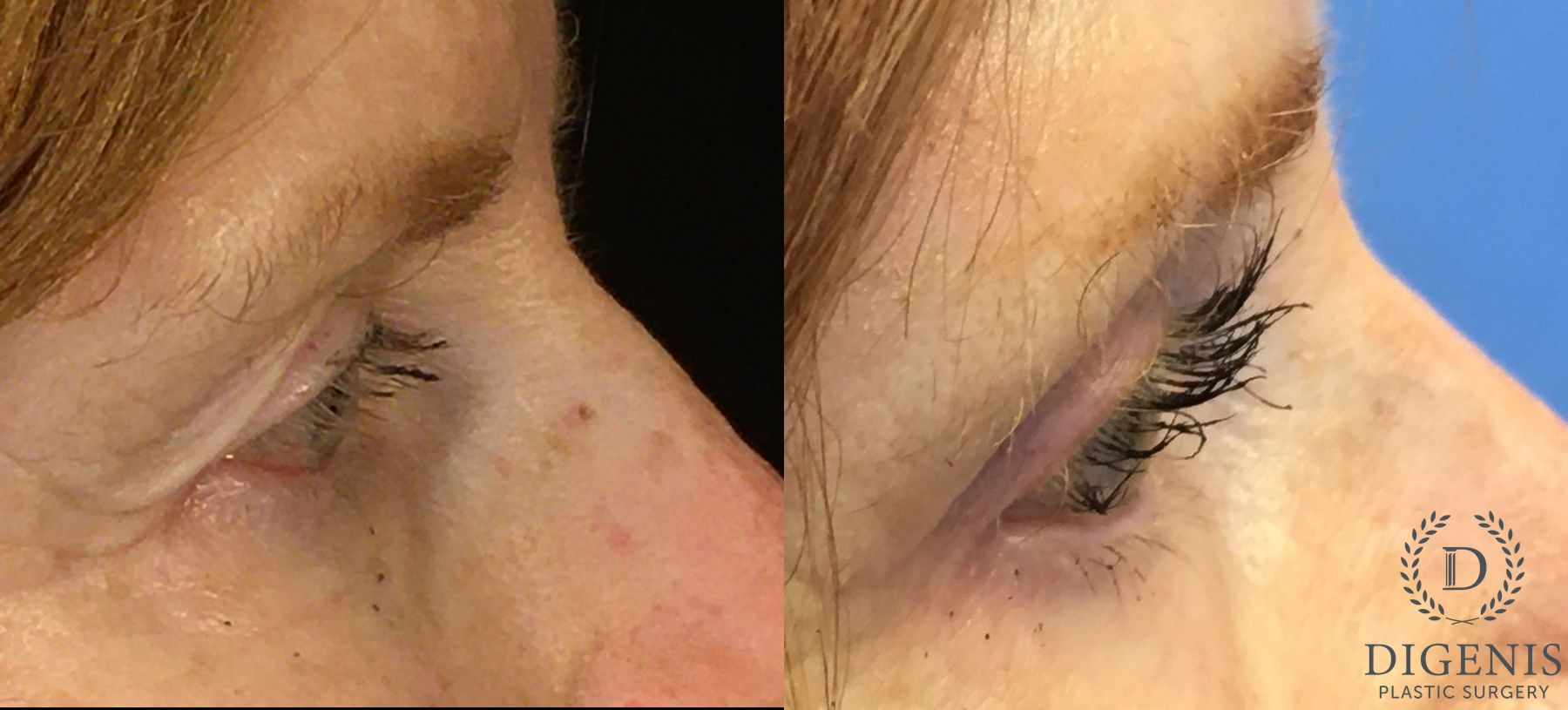 Before and after Eye Lid Surgery case 35153 - Angle 3