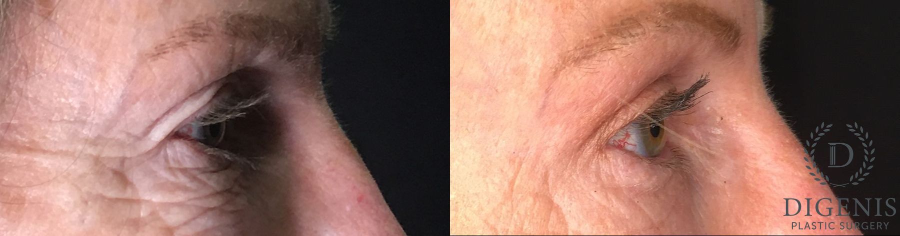 Before and after Eyelid Surgery case 35175 - Angle 3