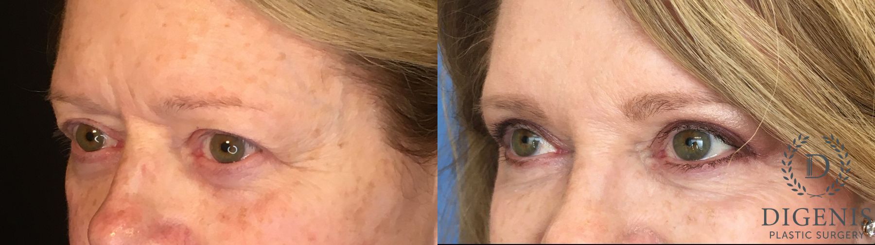 Before and after Eye Lid Surgery case 35146 - Angle 4