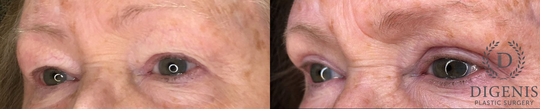 Before and after Eye Lid Surgery case 35170 - Angle 4