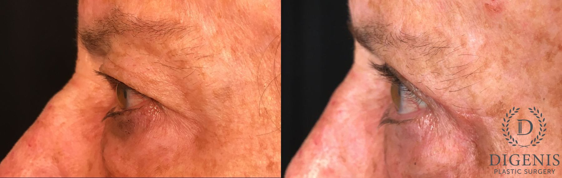 Before and after Eye Lid Surgery case 35193 - Angle 5