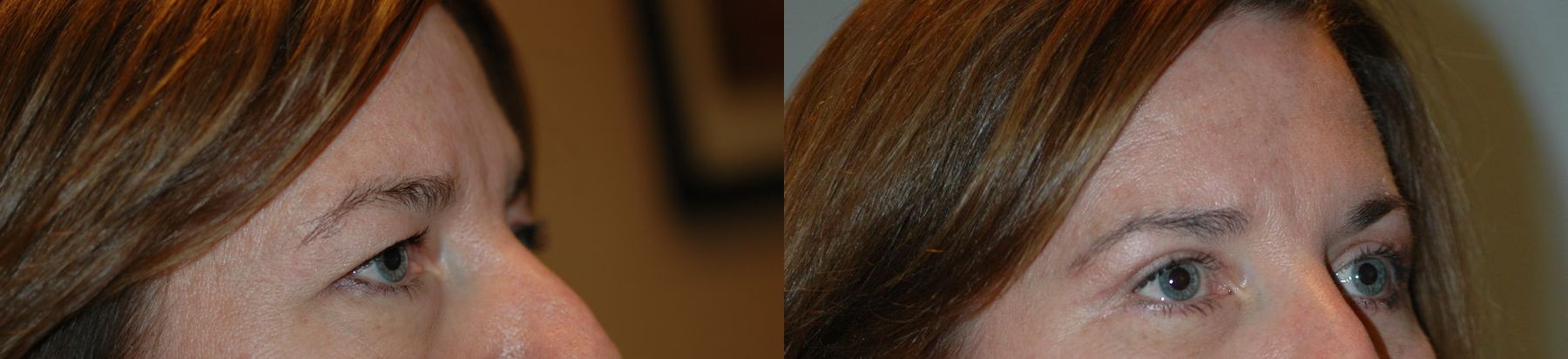 Before and after Eye Lid Surgery case 35086 - Angle 2