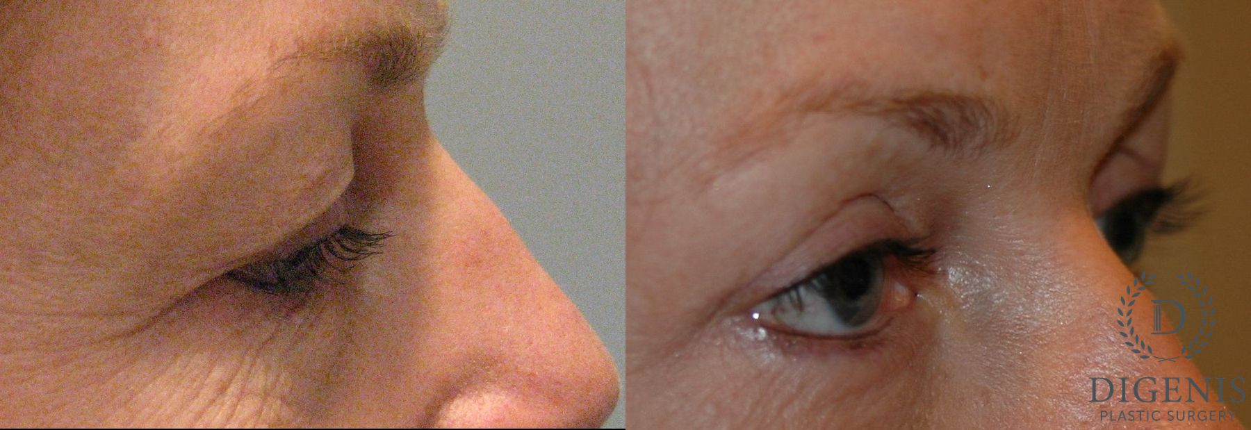 Before and after Eye Lid Surgery case 35101 - Angle 2