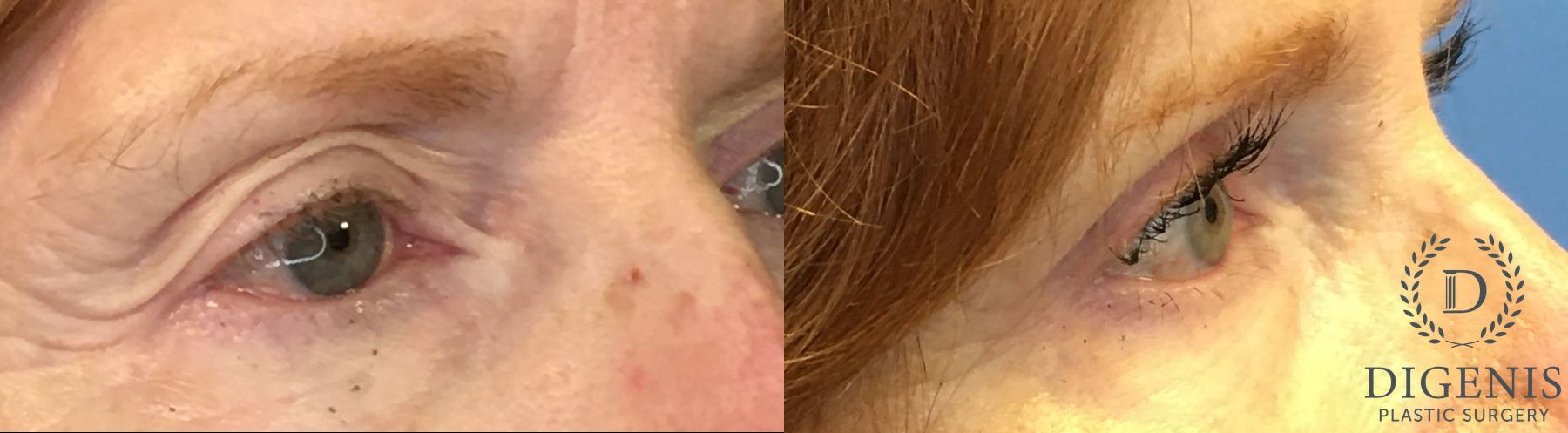 Before and after Eye Lid Surgery case 35153 - Angle 2