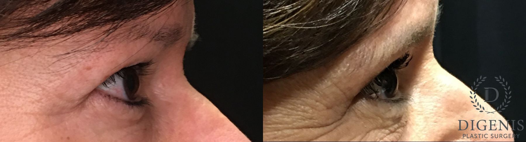 Before and after Eye Lid Surgery case 35192 - Angle 3