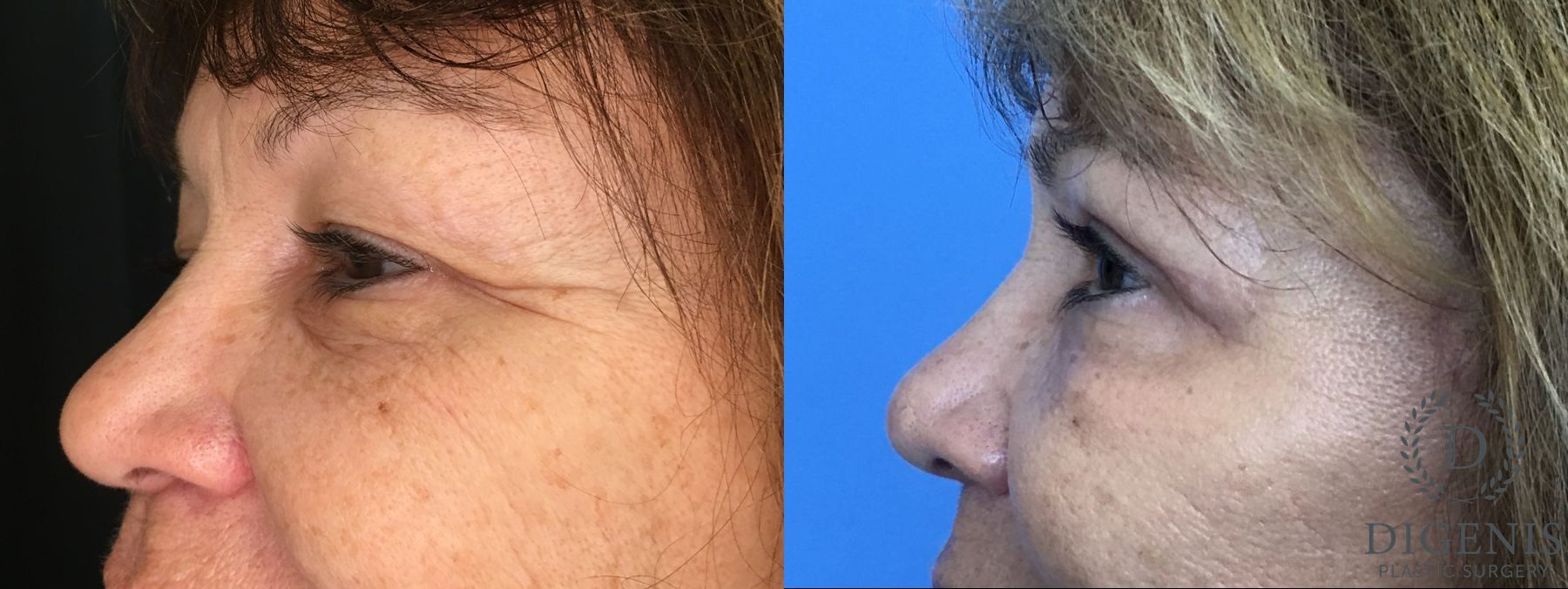 Before and after Eyelid Surgery case 35160 - Angle 5
