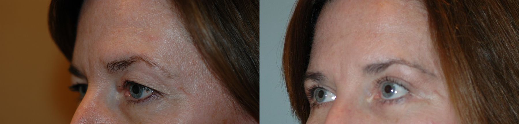 Before and after Eye Lid Surgery case 35086 - Angle 3