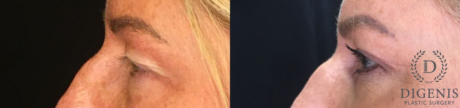 Before and after Eye Lid Surgery case 35151 - Angle 5