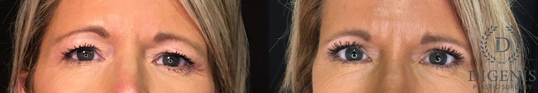 Before and after Eye Lid Surgery case 35150