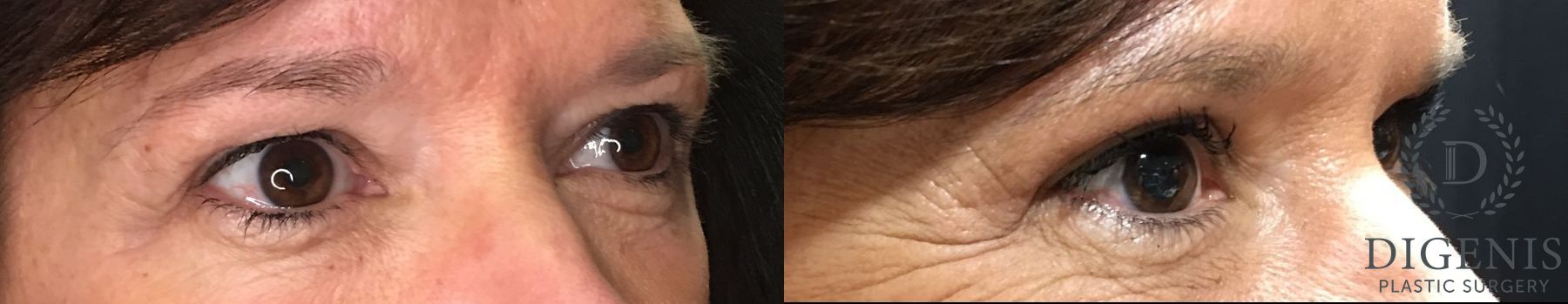 Before and after Eye Lid Surgery case 35192 - Angle 2