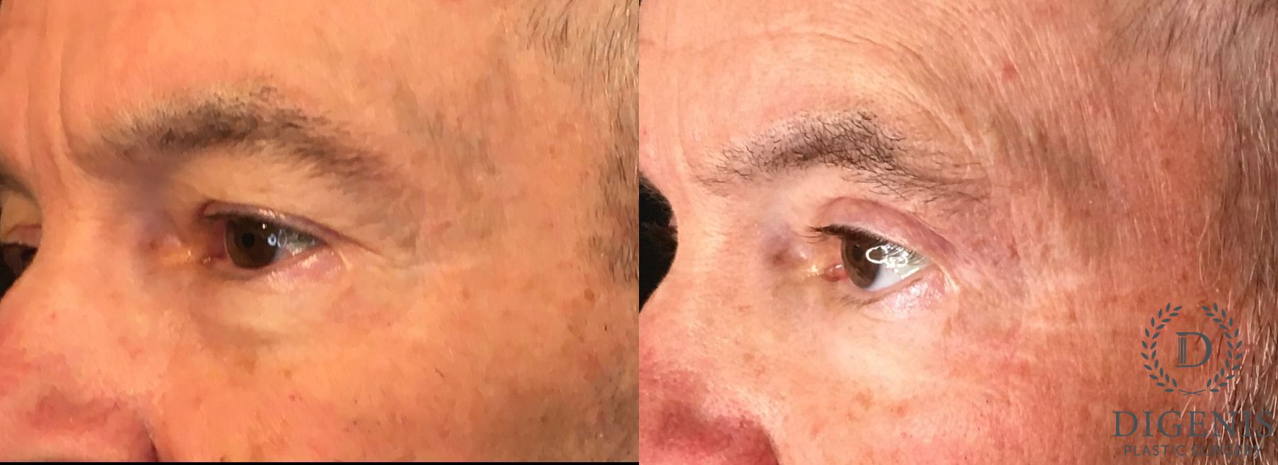 Before and after Eyelid Surgery case 35158 - Angle 4
