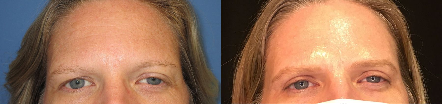 Before and after Eyelid Surgery case 35097