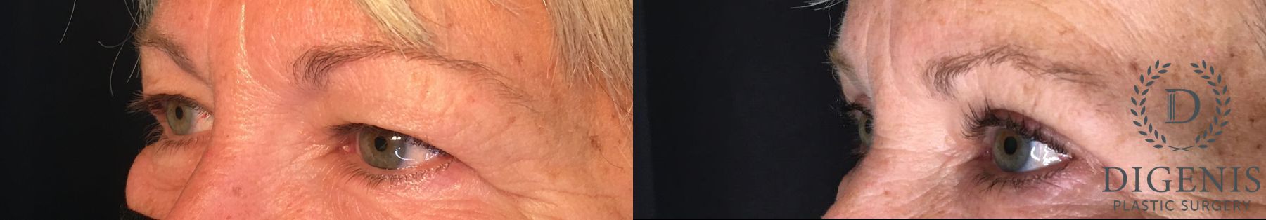 Before and after Eye Lid Surgery case 35208 - Angle 4