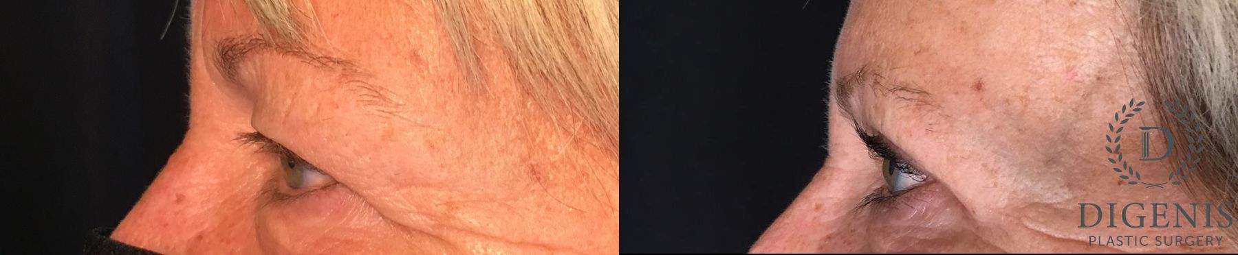 Before and after Eye Lid Surgery case 35208 - Angle 5