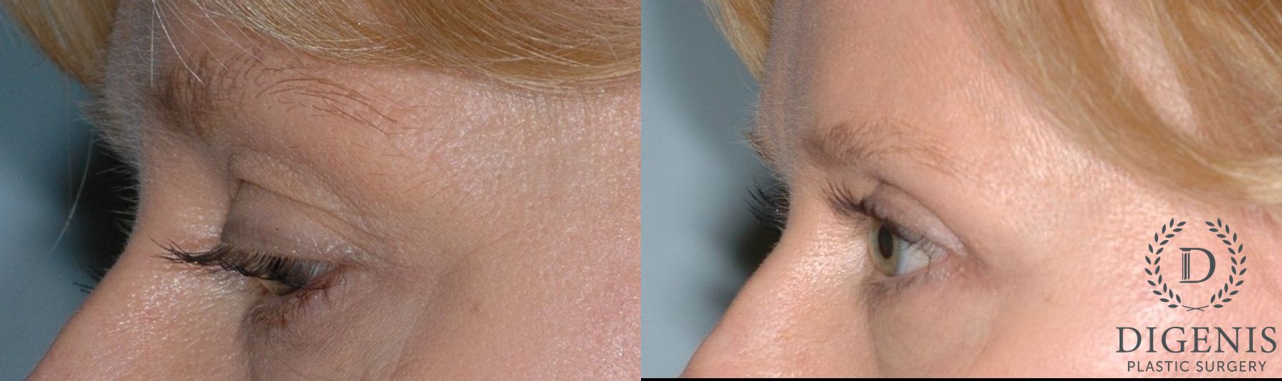 Before and after Eye Lid Surgery case 35104 - Angle 4