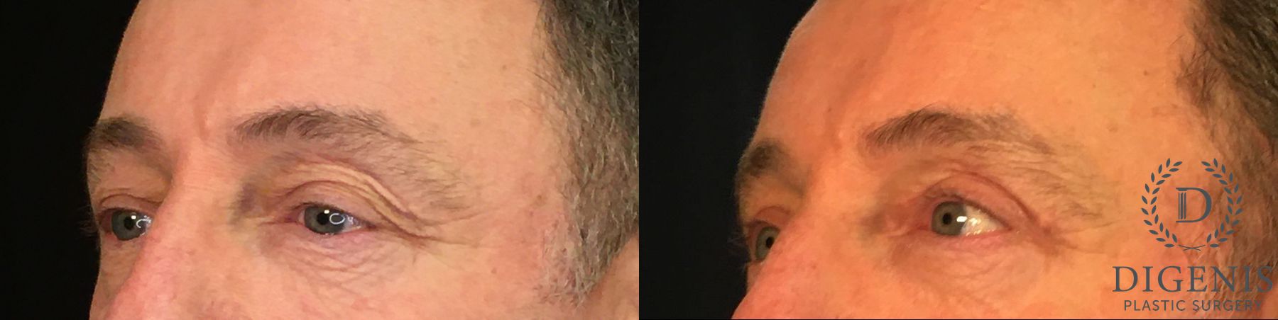 Before and after Eyelid Surgery case 35029 - Angle 4