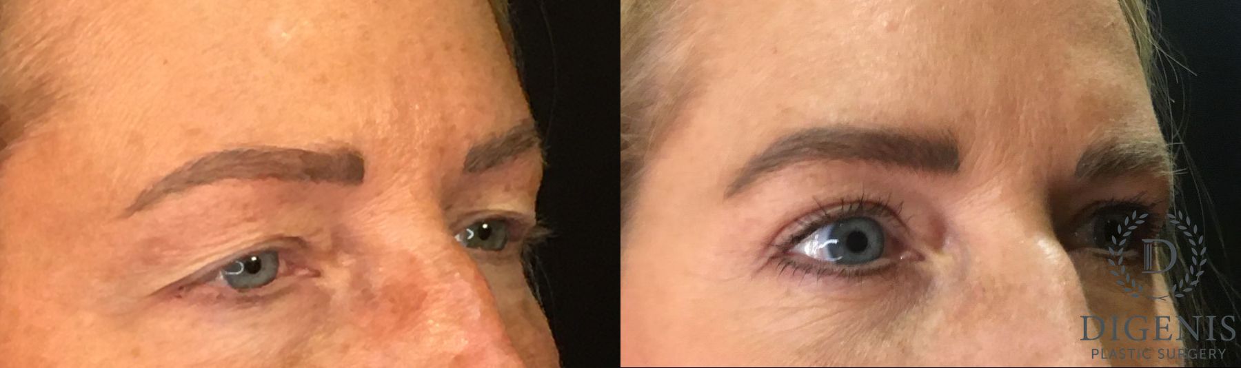 Before and after Eye Lid Surgery case 35151 - Angle 2