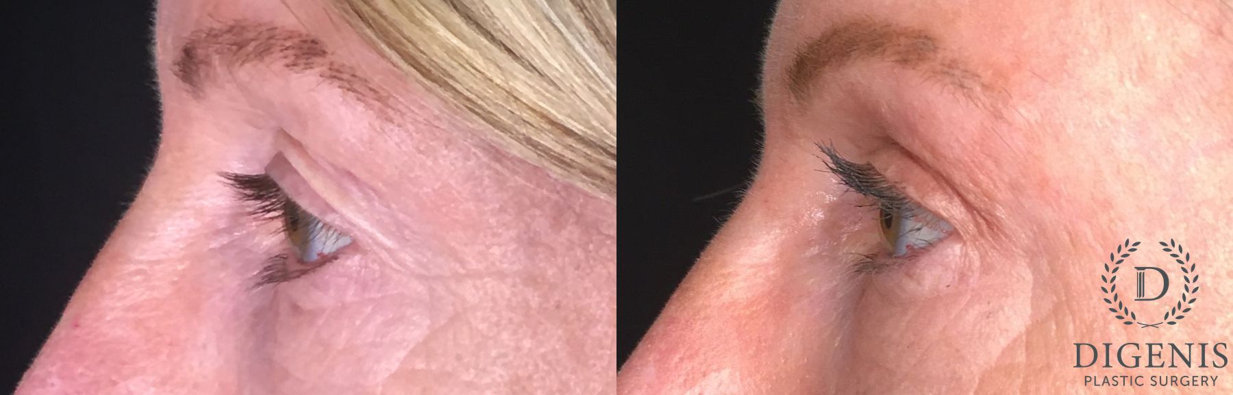 Before and after Eyelid Surgery case 35175 - Angle 5