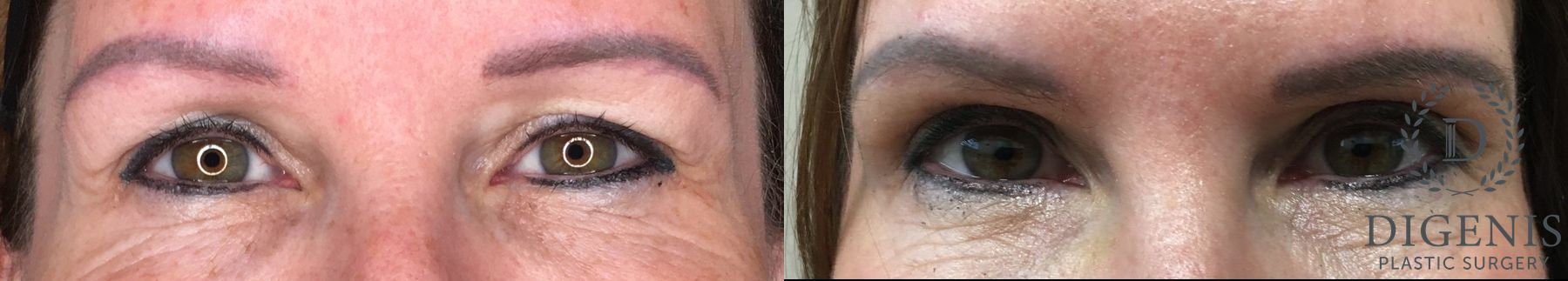 Before and after Eye Lid Surgery case 35179