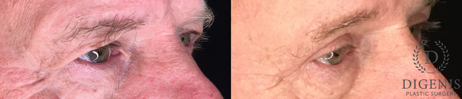 Before and after Eye Lid Surgery case 35183 - Angle 2