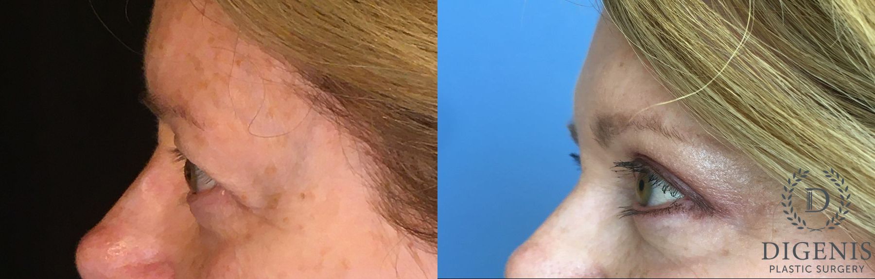 Before and after Eye Lid Surgery case 35146 - Angle 5