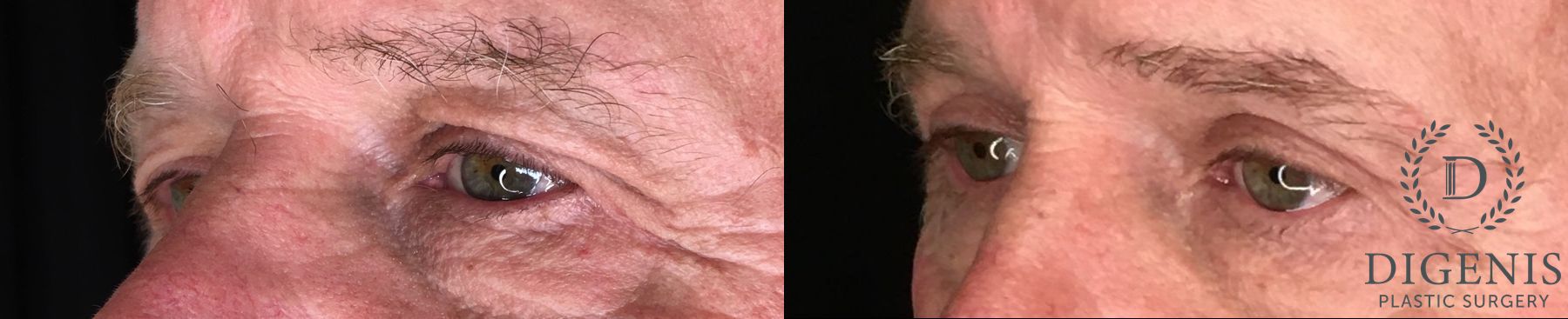 Before and after Eye Lid Surgery case 35183 - Angle 4