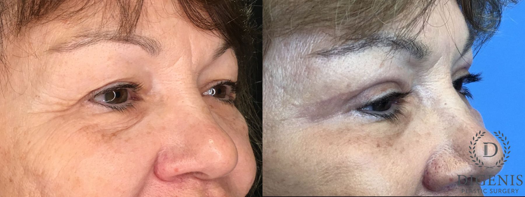 Before and after Eyelid Surgery case 35160 - Angle 2
