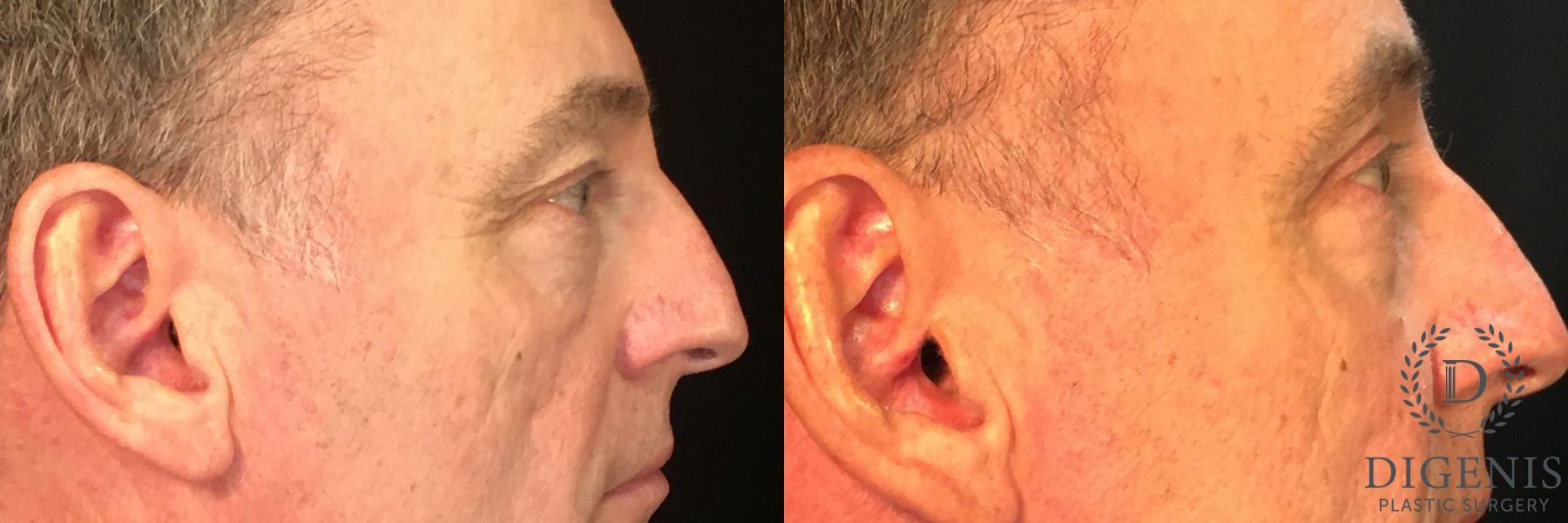 Before and after Eyelid Surgery case 35029 - Angle 3