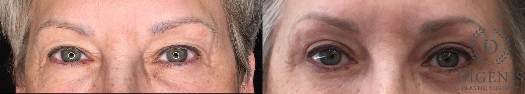 Before and after Eye Lid Surgery case 35190