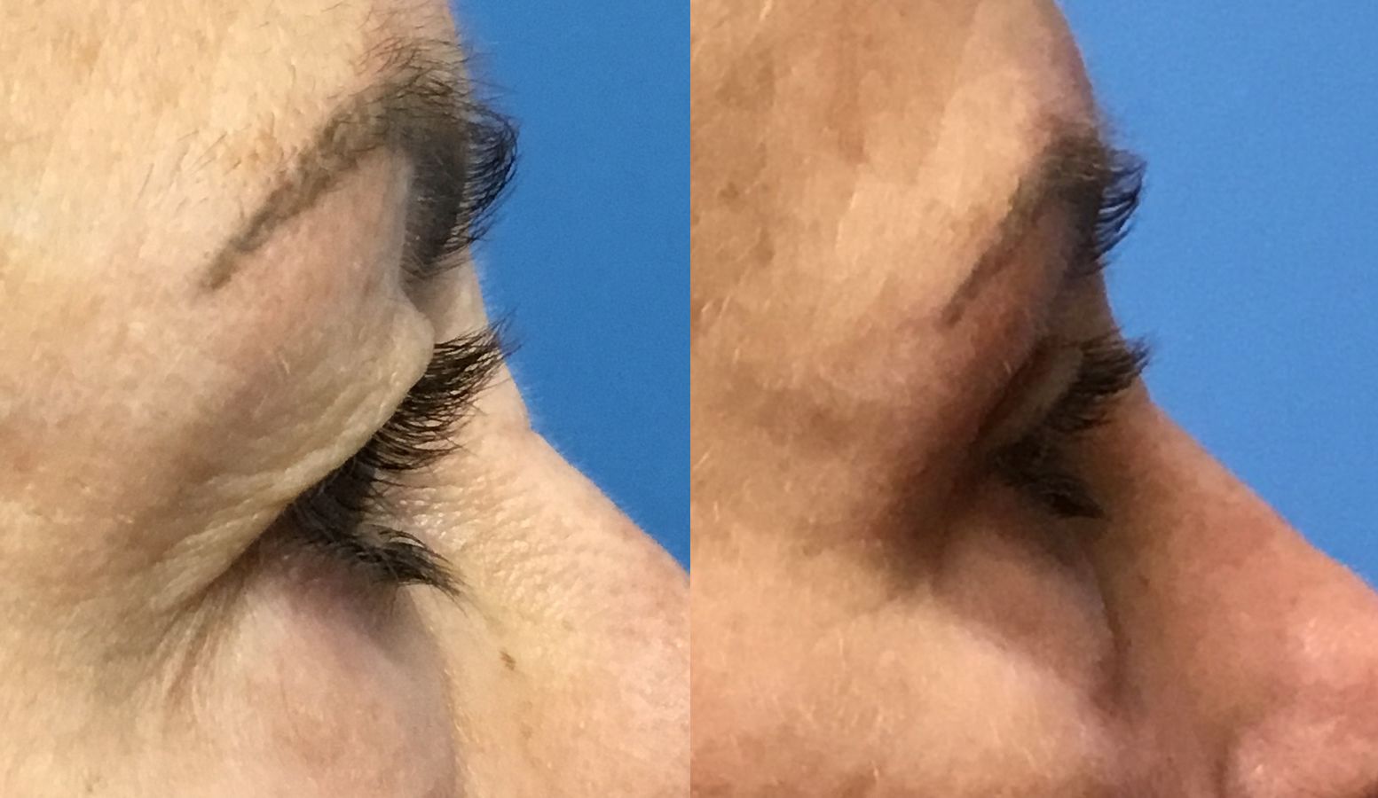 Before and after Eye Lid Surgery case 35112 - Angle 3