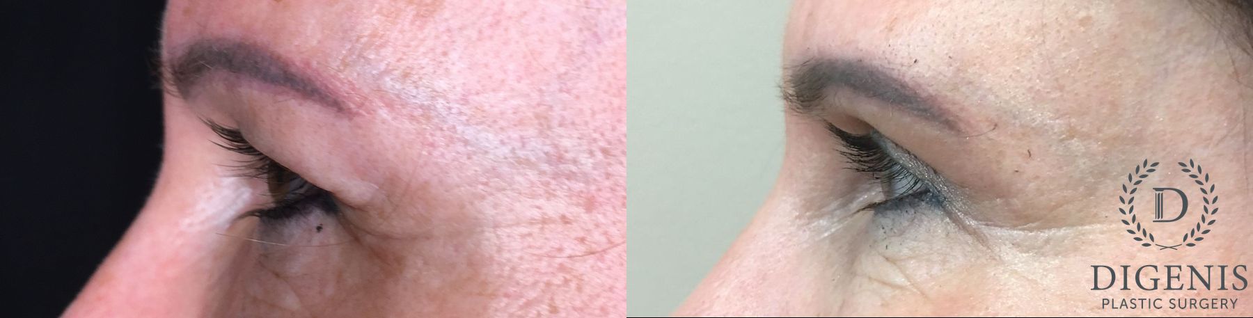 Before and after Eye Lid Surgery case 35179 - Angle 5