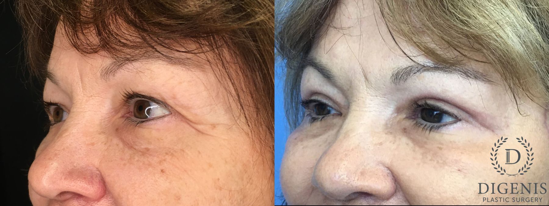 Before and after Eyelid Surgery case 35160 - Angle 4