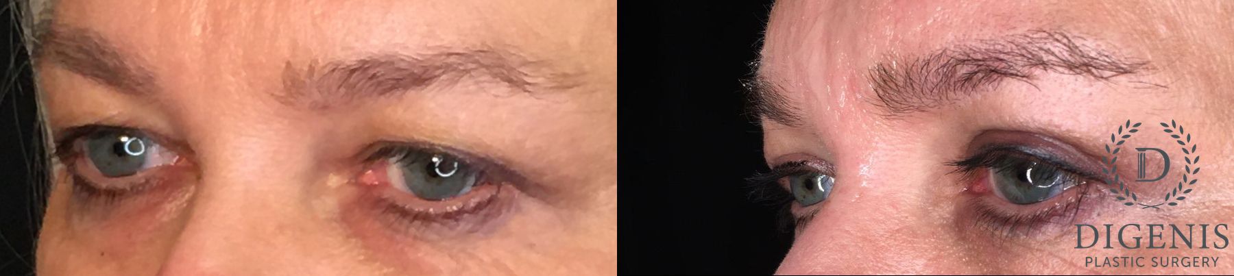 Before and after Eyelid Surgery case 35161 - Angle 2