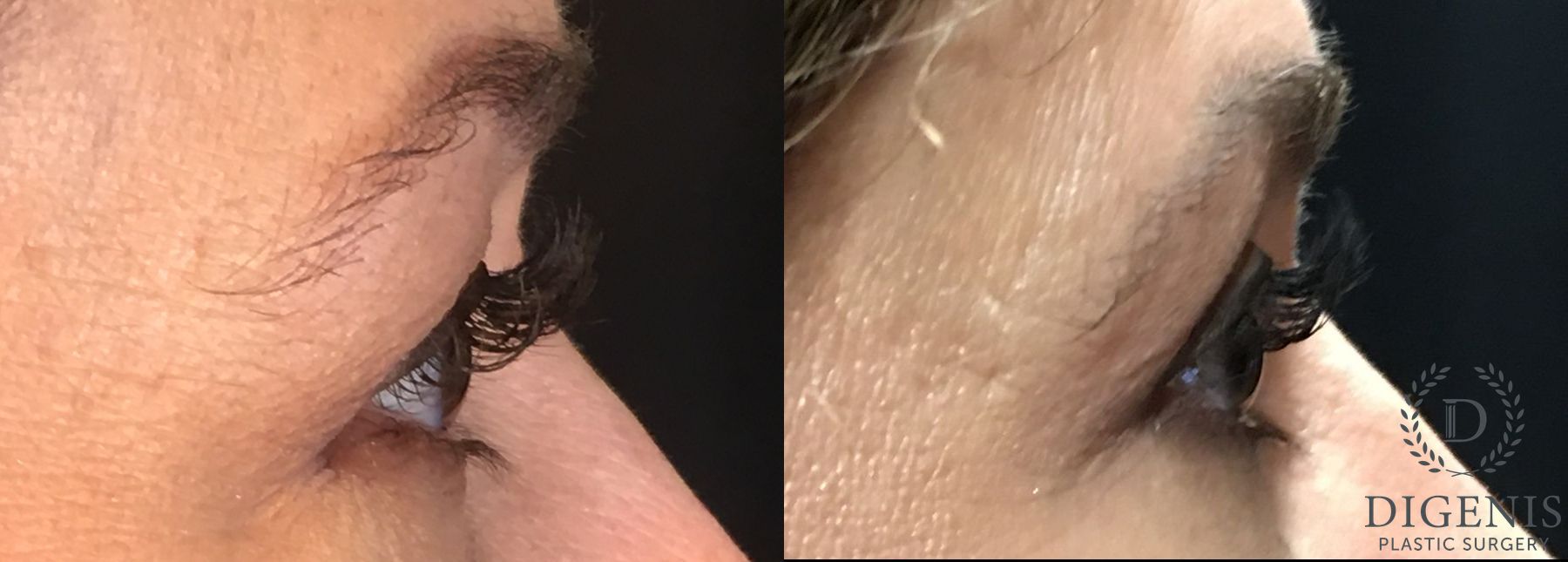 Before and after Eye Lid Surgery case 35189 - Angle 3