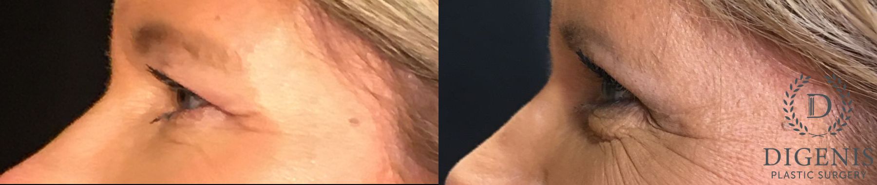 Before and after Eye Lid Surgery case 35150 - Angle 5