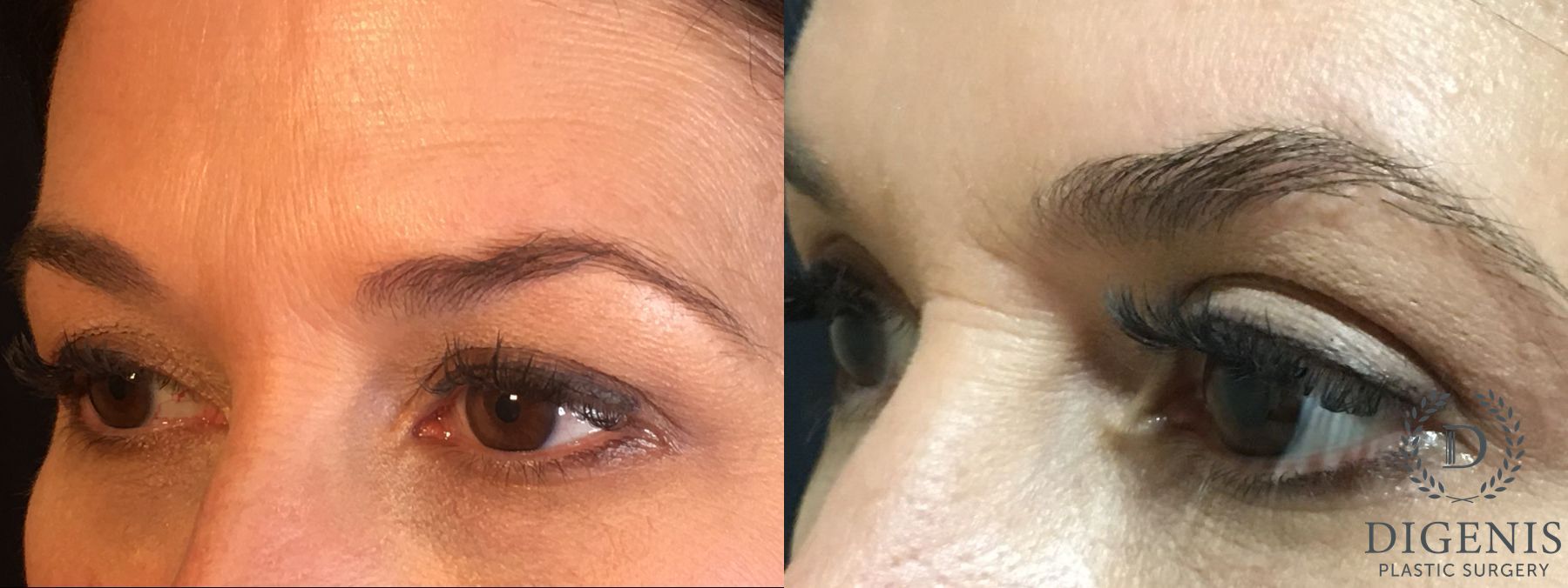 Before and after Eye Lid Surgery case 35189 - Angle 4