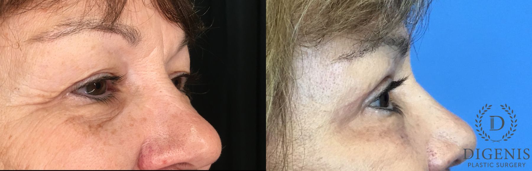 Before and after Eyelid Surgery case 35160 - Angle 3
