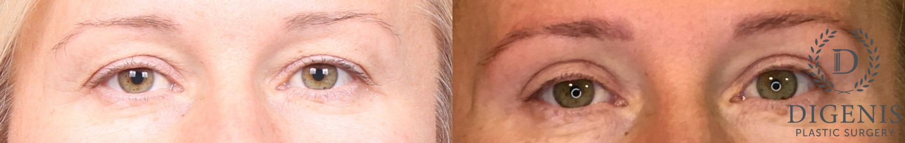 Before and after Eye Lid Surgery case 35108