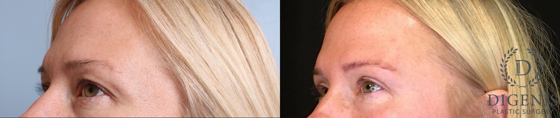 Before and after Eye Lid Surgery case 35108 - Angle 3