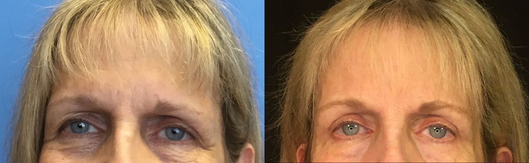 Before and after Eyelid Surgery case 35109
