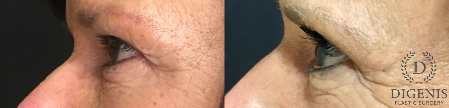 Before and after Eye Lid Surgery case 35192 - Angle 5