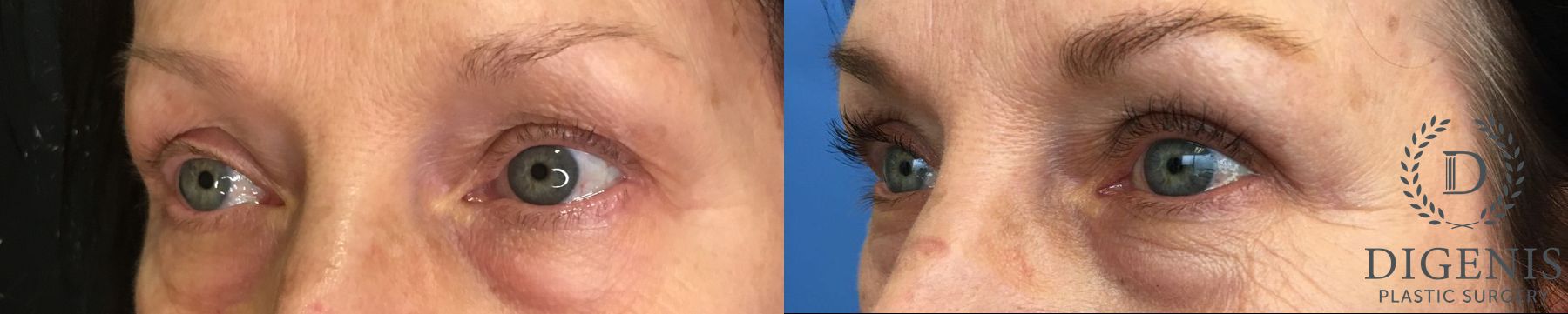 Before and after Eyelid Surgery case 35163 - Angle 4