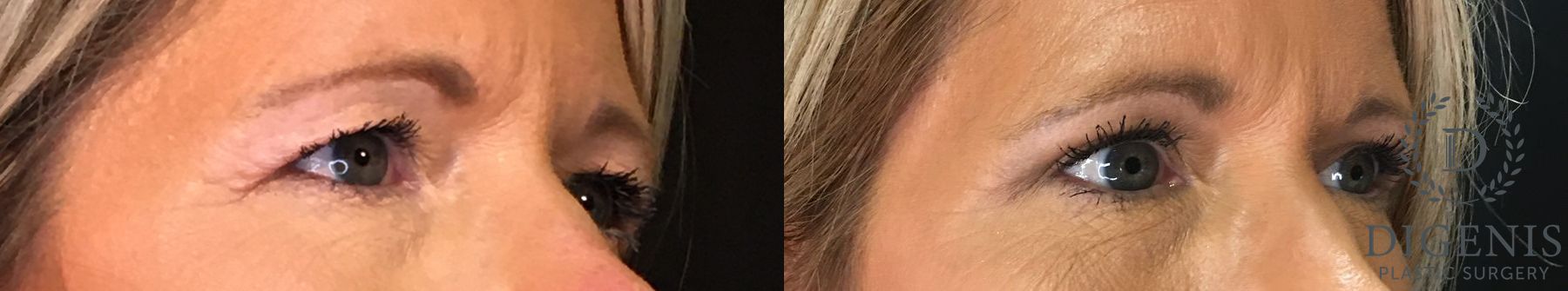 Before and after Eye Lid Surgery case 35150 - Angle 2