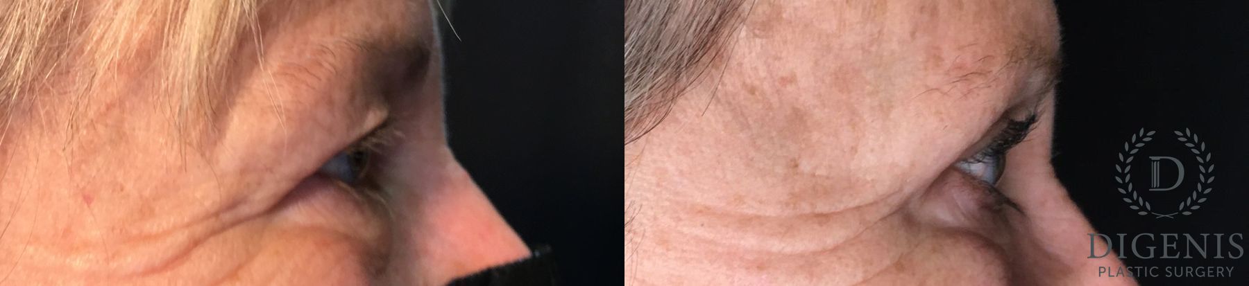 Before and after Eye Lid Surgery case 35208 - Angle 3