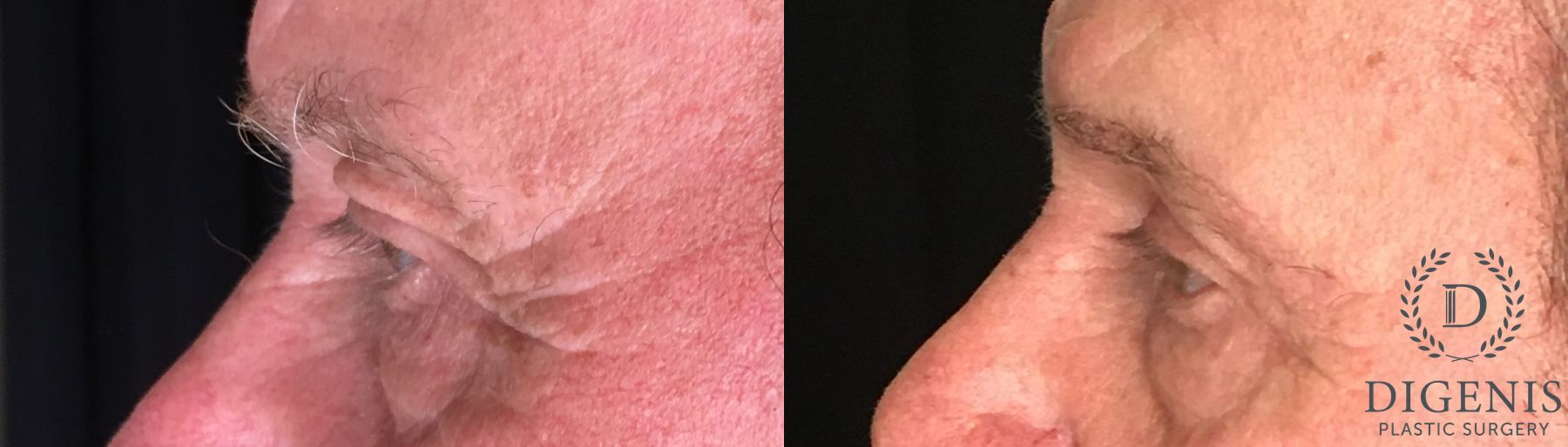 Before and after Eye Lid Surgery case 35183 - Angle 5