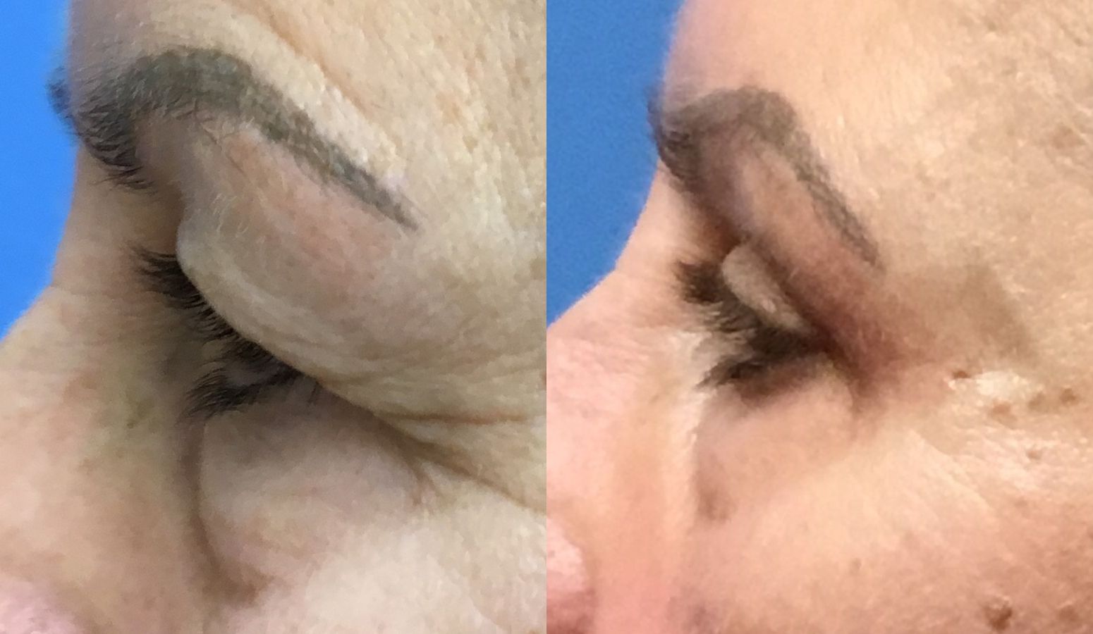 Before and after Eye Lid Surgery case 35112 - Angle 5