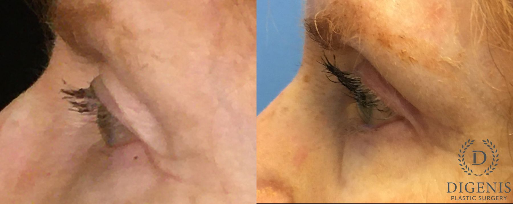 Before and after Eye Lid Surgery case 35153 - Angle 5