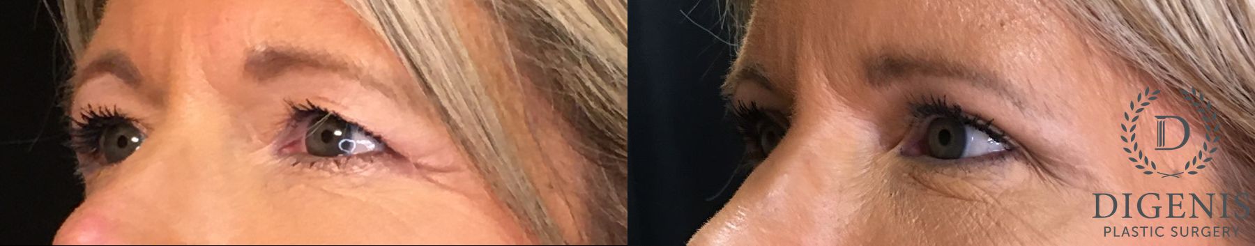 Before and after Eye Lid Surgery case 35150 - Angle 4